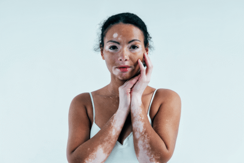 beautiful-woman-with-vitiligo-skin